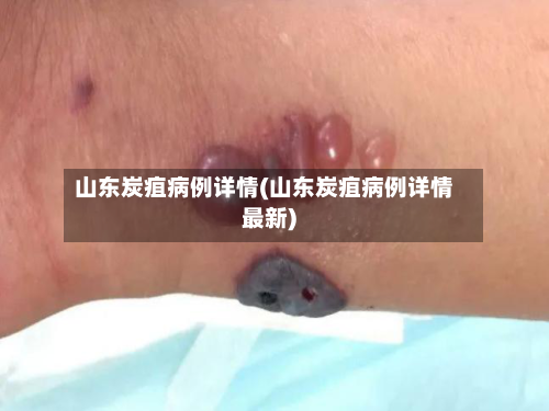 山东炭疽病例详情(山东炭疽病例详情最新)-第3张图片