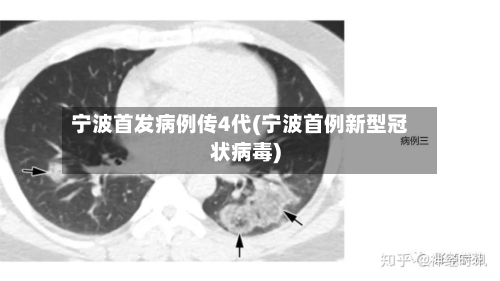 宁波首发病例传4代(宁波首例新型冠状病毒)-第2张图片